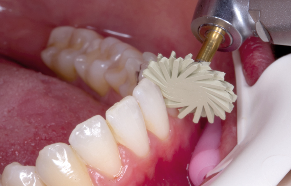 Ziel: Automatisierung des Polierprozesses der Zahnprodukte