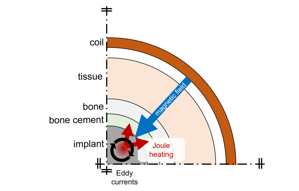 Schematic representation of inductive heating of endoprostheses with bone cement. (Graphic: Evers)